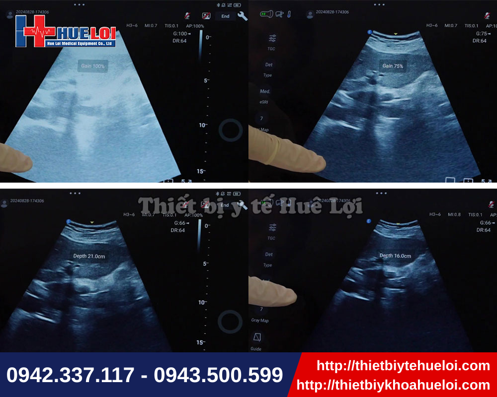 Hình ảnh siêu âm sắc nét với máy siêu âm chẩn đoán di động