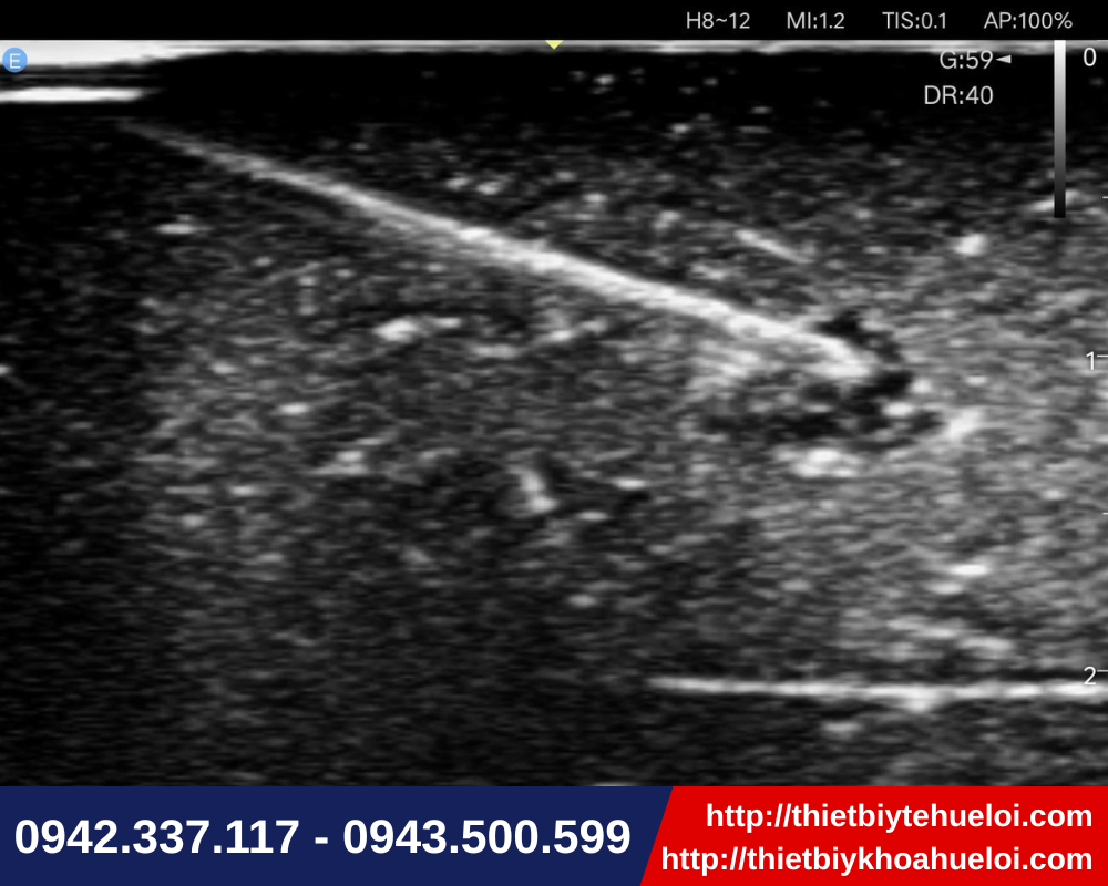 Máy siêu âm cầm tay hỗ trợ kim dẫn hướng