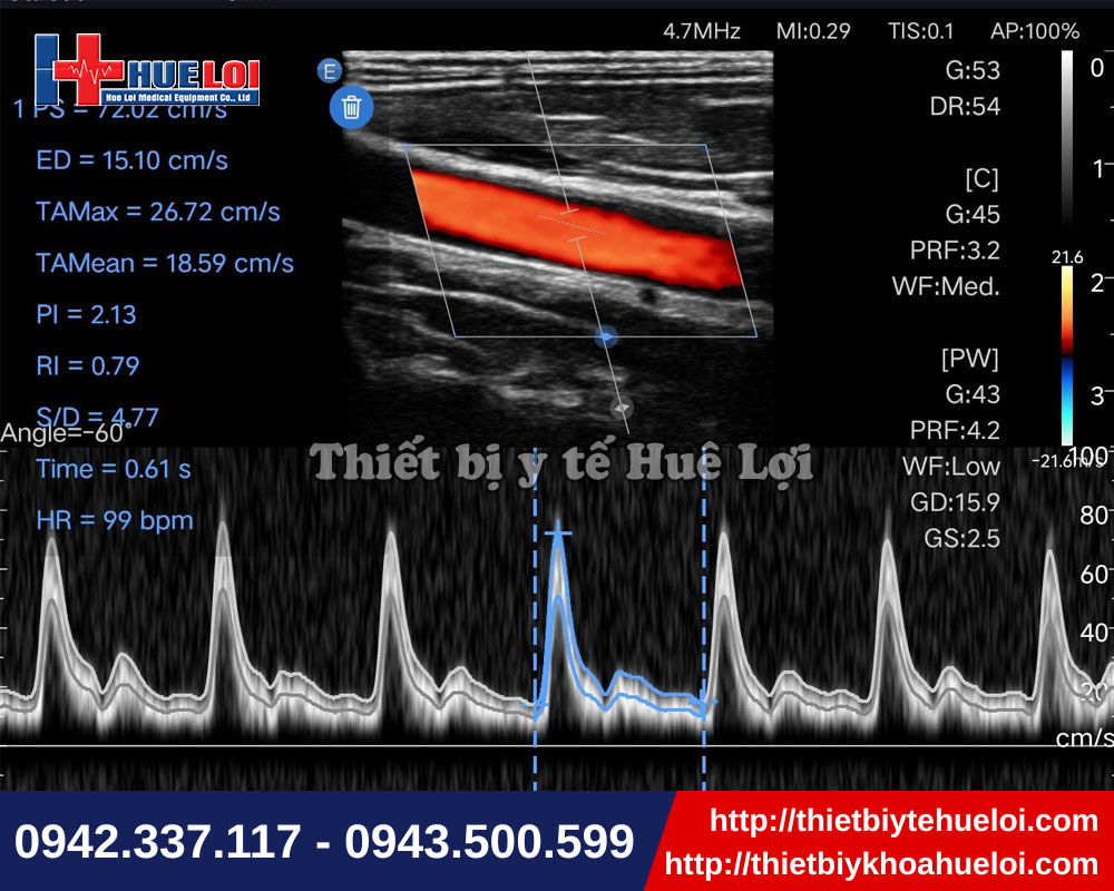 Chế độ doppler xung trên thiết bị siêu âm cầm tay
