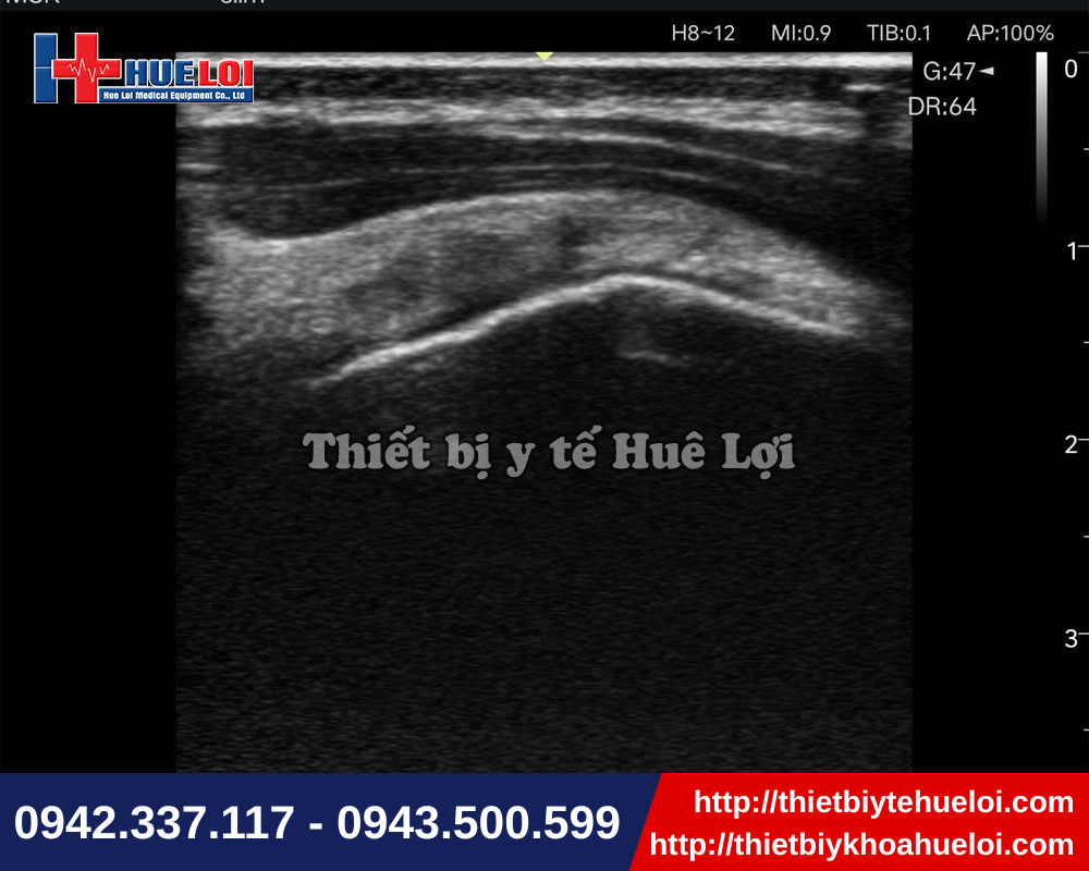 Máy siêu âm di động cho hình ảnh siêu âm cơ xương khớp sắc nét