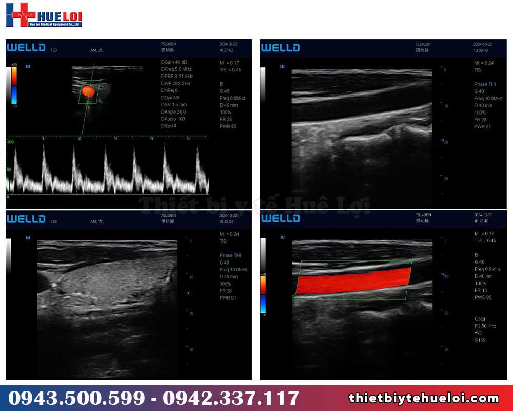 kết quả hình ảnh máy siêu âm doppler màu giá rẻ