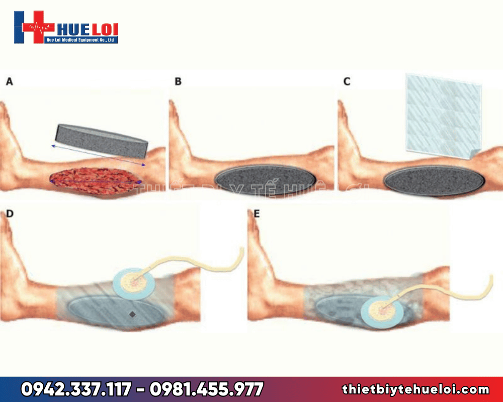 Hướng dẫn sử dụng máy hút áp lực âm điều trị NP-100